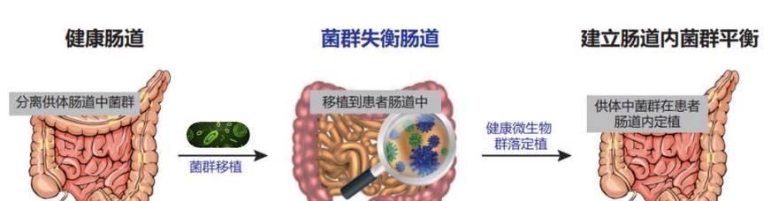 粪菌移植（揭开粪菌移植的奇妙世界，探索肠道健康的新前沿）